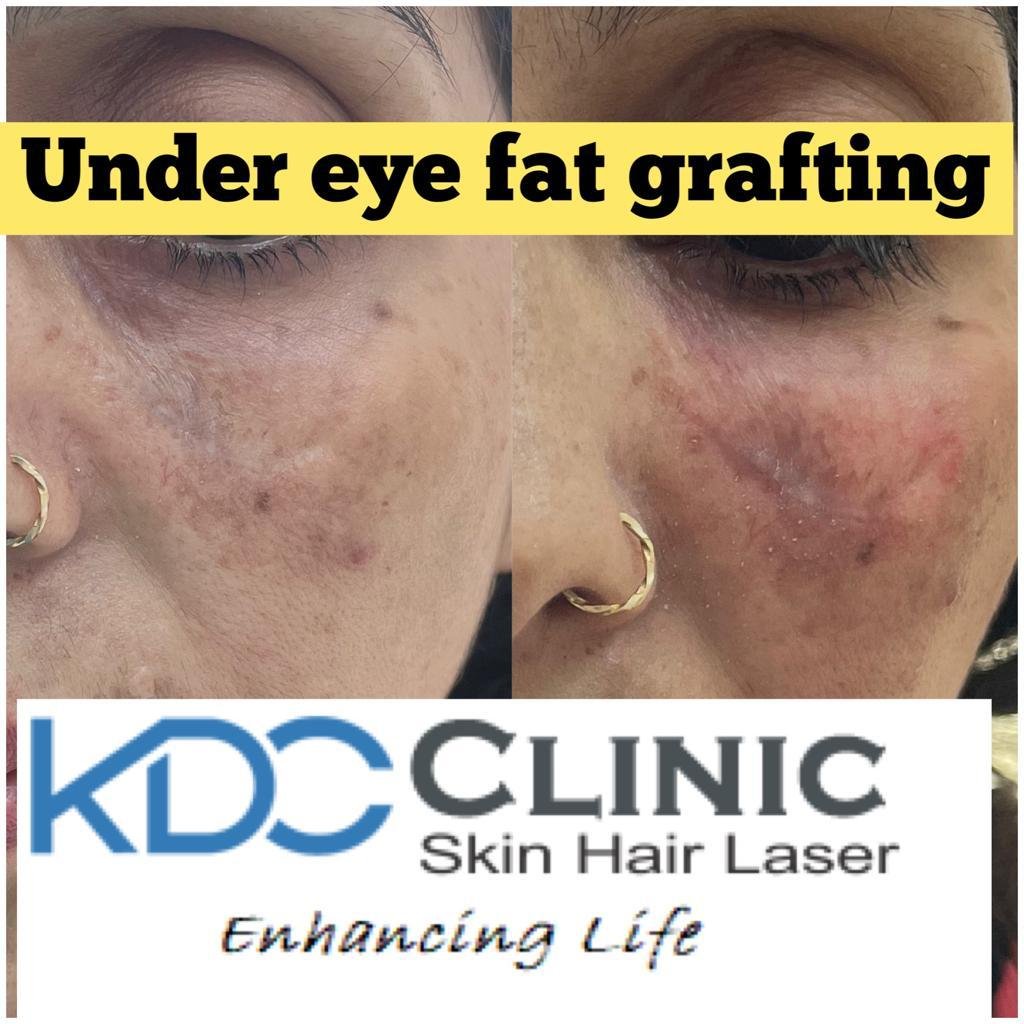 Under Eye Grafting Under Eye Grafting