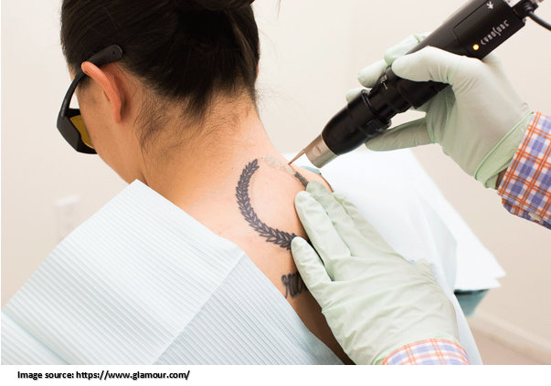 Tattoo removal procedure | Dr Leena Jain