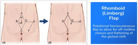 rhomboid flap