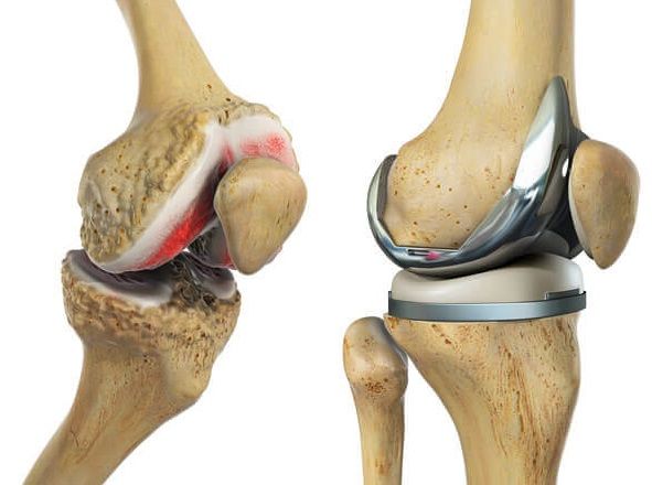 Total Knee Replacement Recovery: What To Expect - Knee Pain Explained