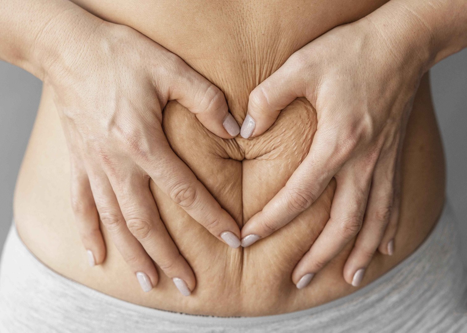 Dermaroller for stretch marks