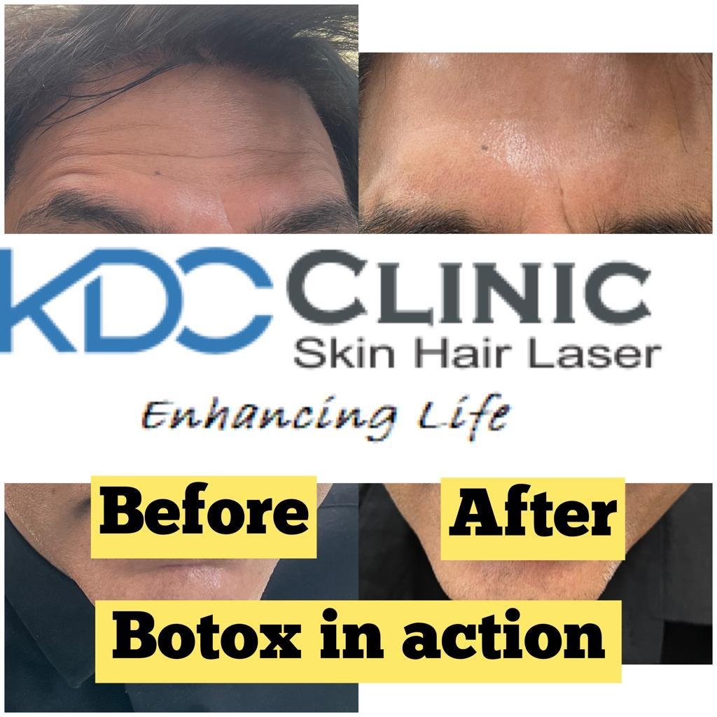 Botox Botox