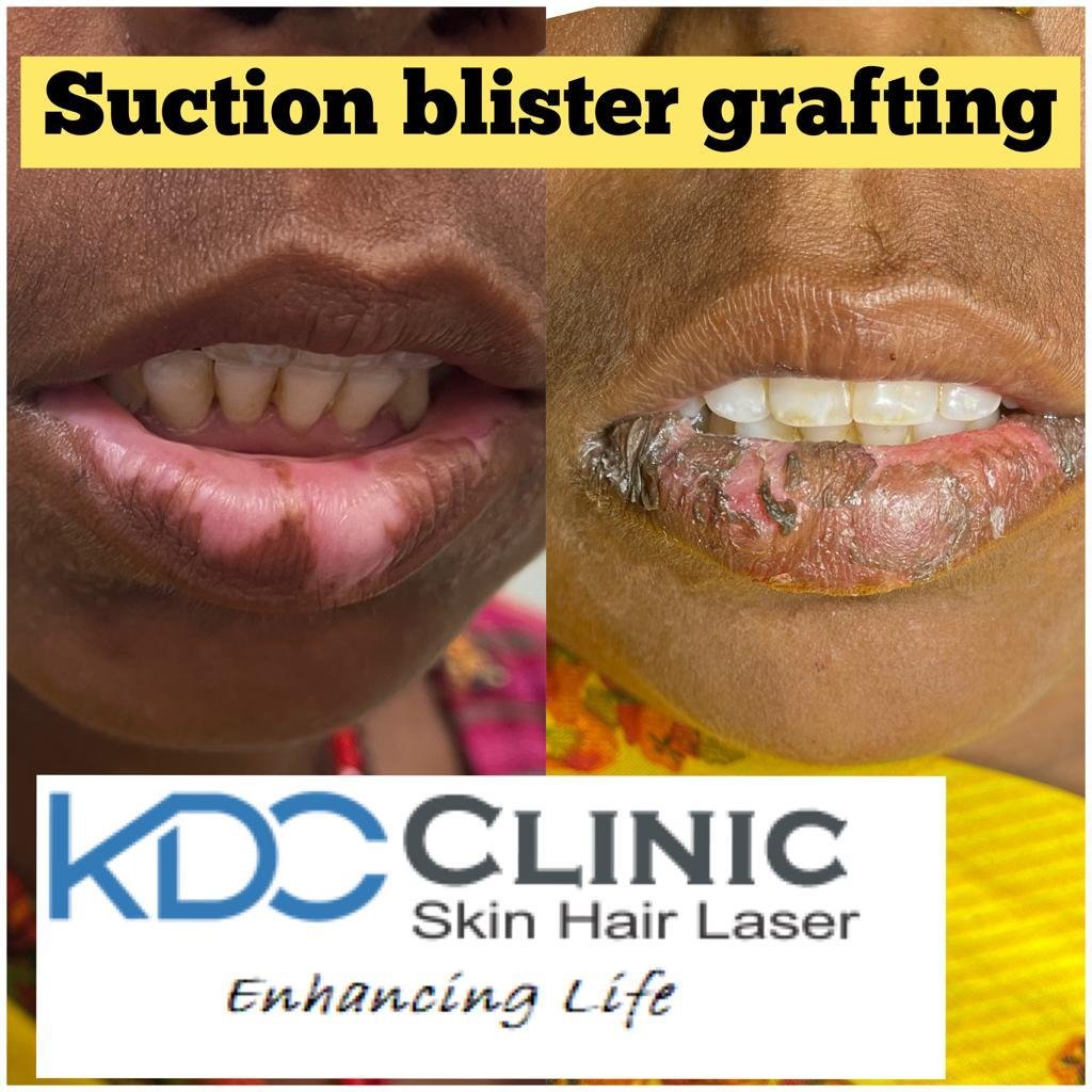 Suction Blister Grafting Suction Blister Grafting