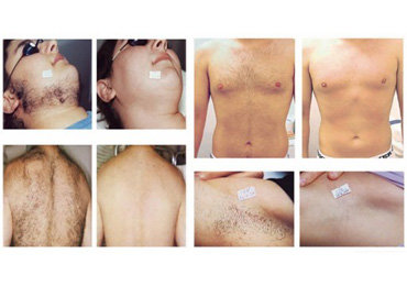 Diode Laser Hair Removal Treatment Before & after