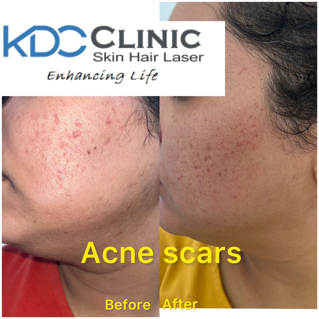 Acne Scar Treatment Acne Scar Treatment