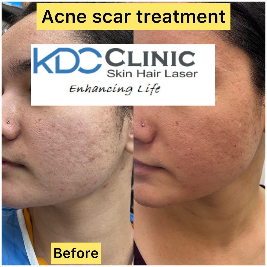 acne-scar-treatment-in-faridabad acne-scar-treatment-in-faridabad