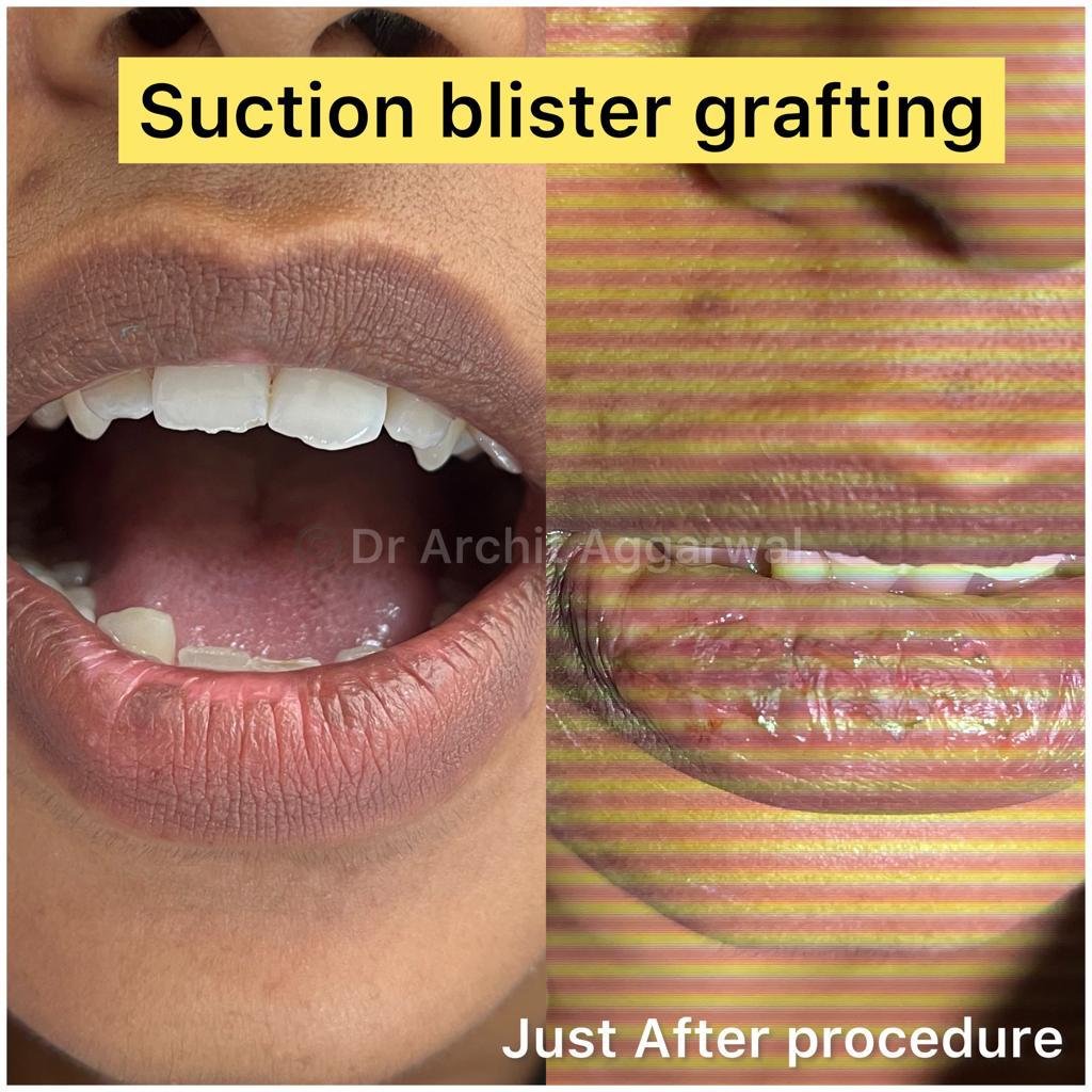 Suction Blister Grafting Suction Blister Grafting