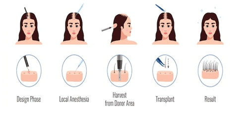 Follicular Unit Extraction (FUE)