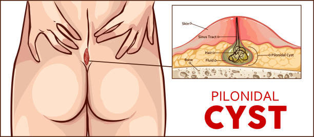 Pilonidal Cyst