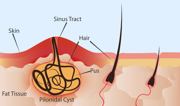 Complications associated with Pilonidal Sinus