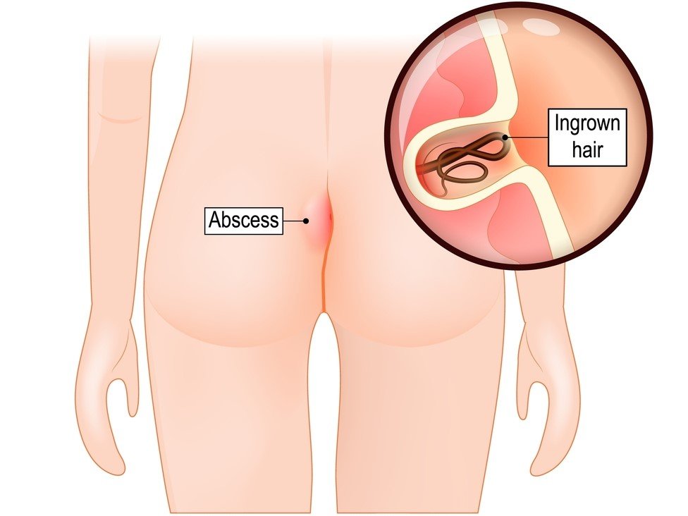 Signs and Symptoms of Pilonidal Sinus