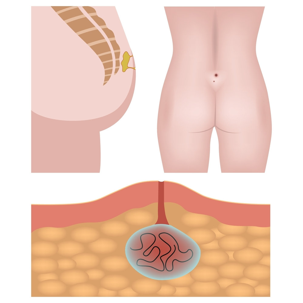 Pilonidal sinus: Symptoms, pictures, and treatment