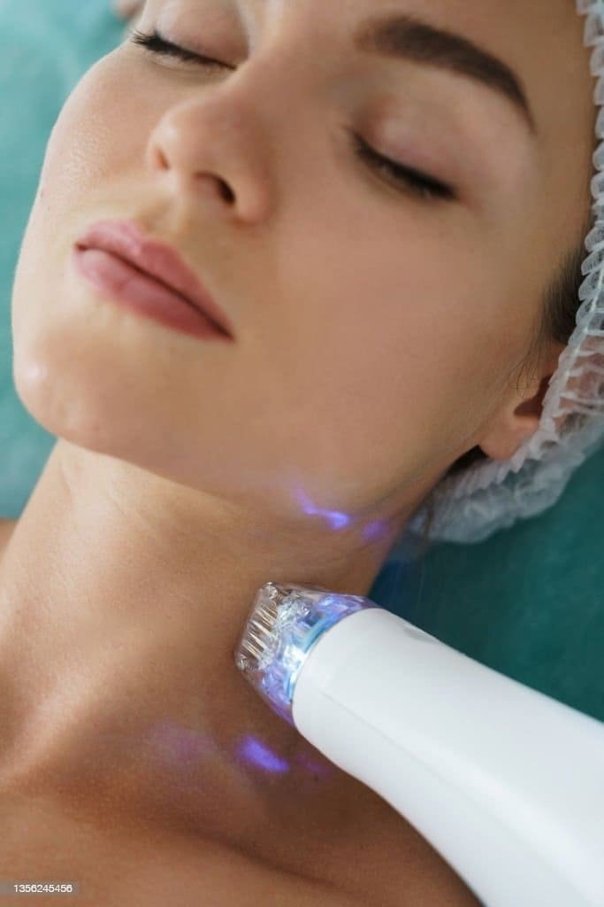 Microneedling Radiofrequency Treatment
