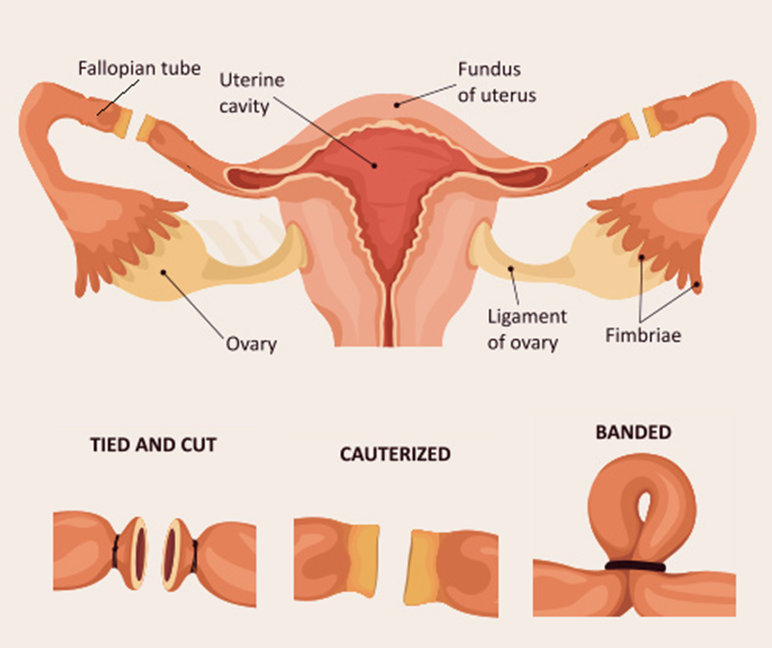 Different types of tubal ligation