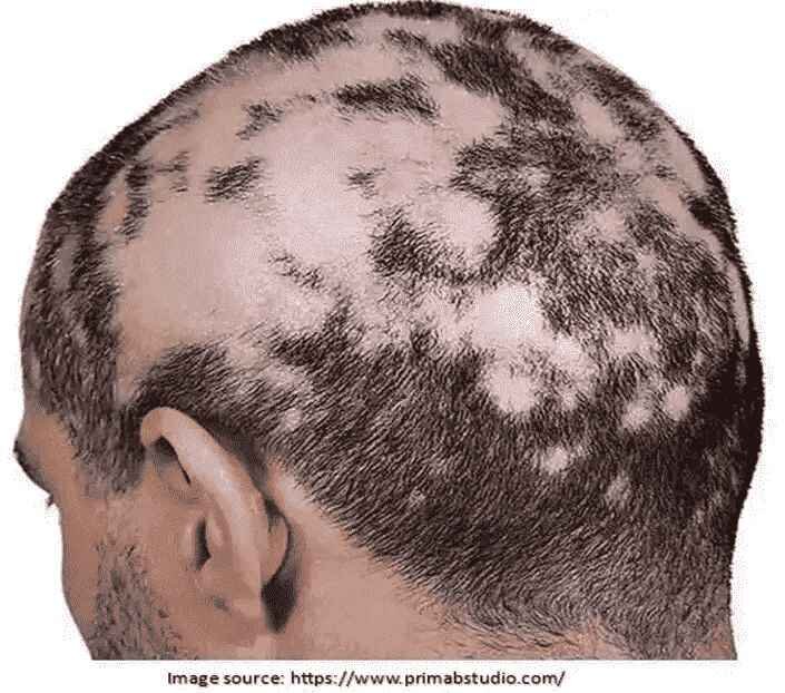 Hair Transplant for Scarring Alopecia