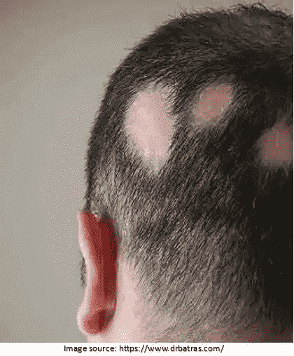 Permanent Secondary Scarring Alopecia