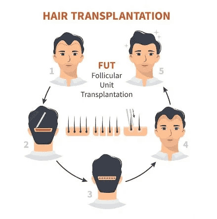 Follicular Unit Transplantation