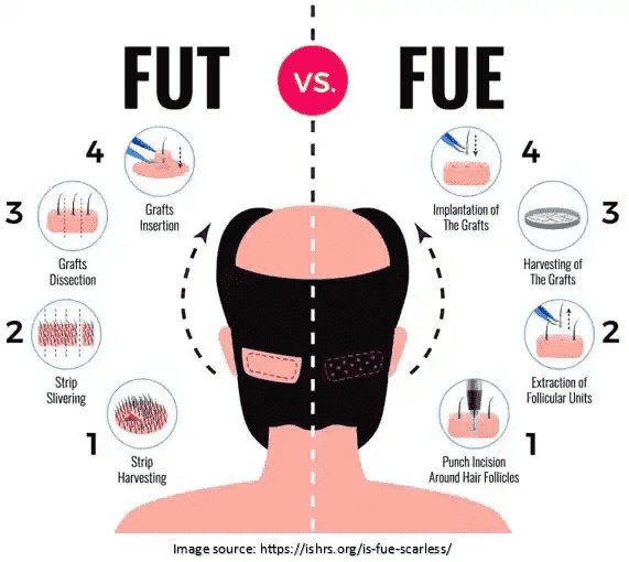 Follicular Unit Extraction