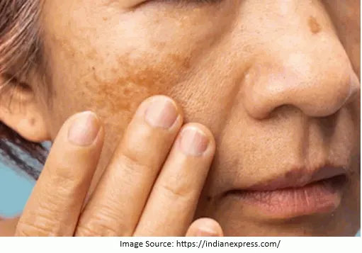 Post-inflammatory Hyperpigmentation