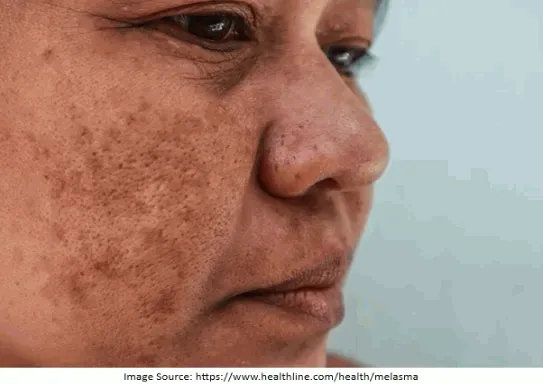 Melasma