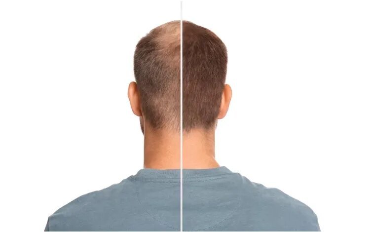 6 Years after Hair Transplant
