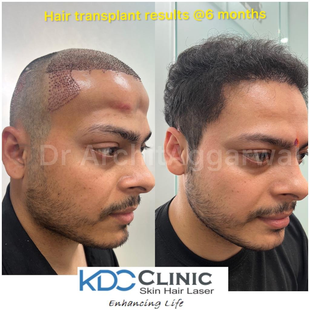 hair-transplant-treatment-in-faridabad hair-transplant-treatment-in-faridabad