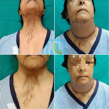 Neck Contracture Post Burns