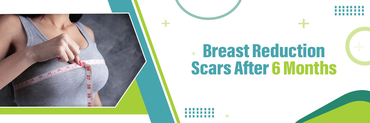Breast Reduction Scars After 6 Months Breast Reduction Scars After 6 Months
