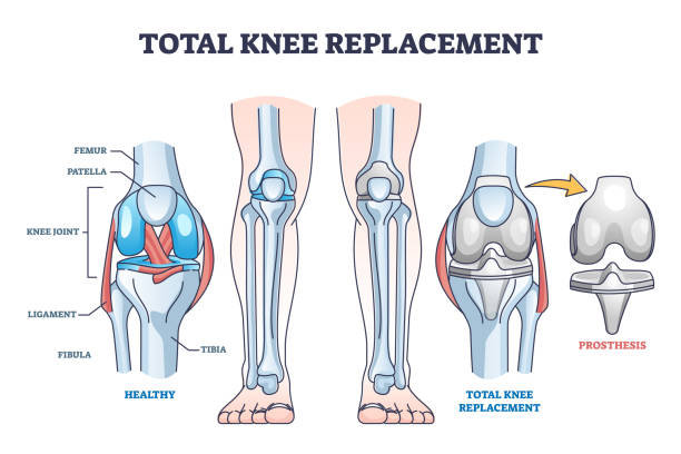 Pain 3 Months After Knee Replacement