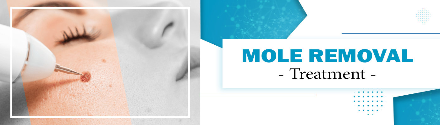 mole-removal-treatment-in-faridabad mole-removal-treatment-in-faridabad