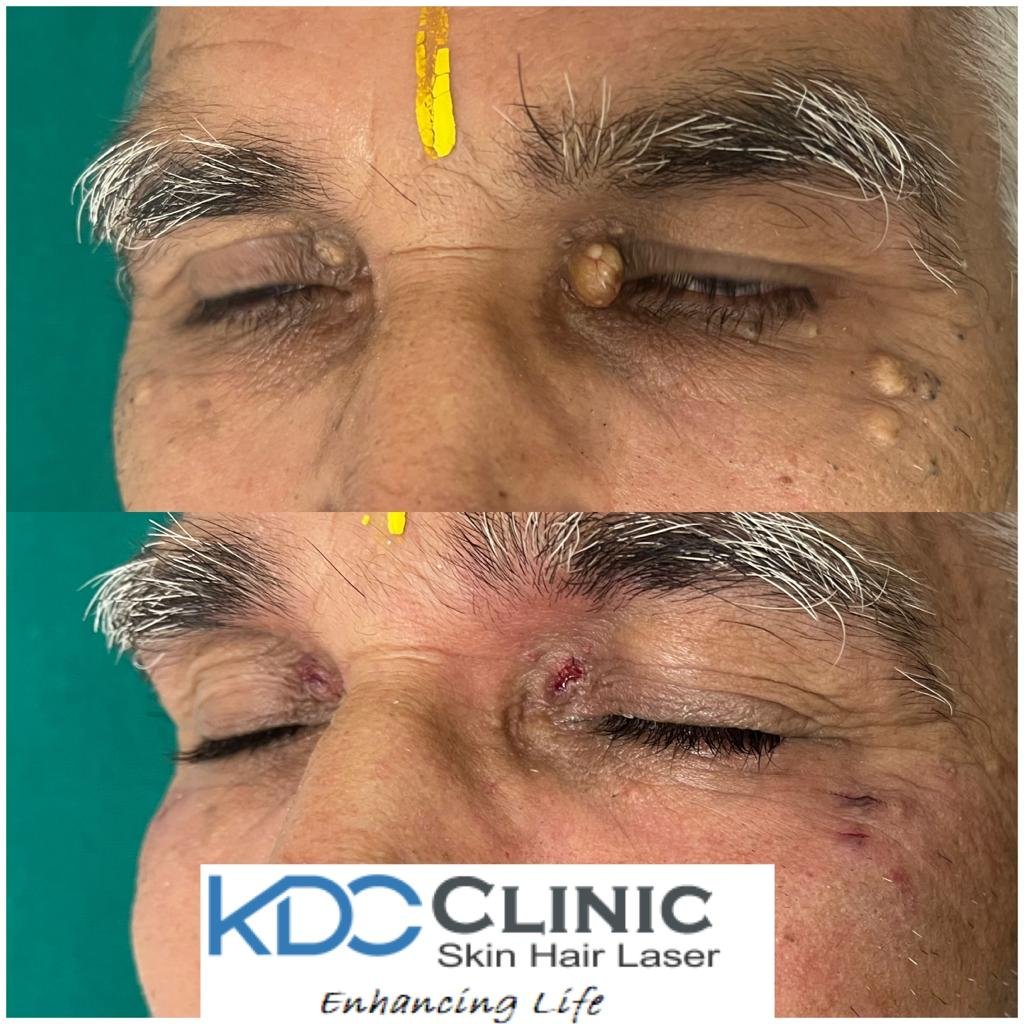 mole-removal-treatment mole-removal-treatment