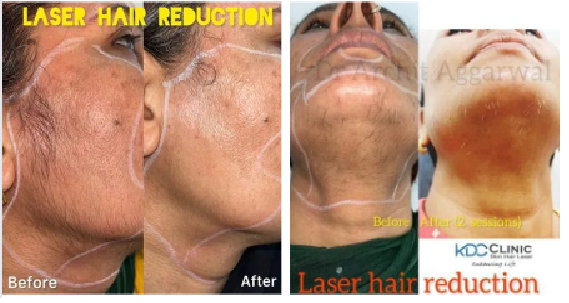 Results of Face Laser Hair Treatment 