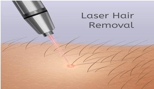 laser-hair-removal