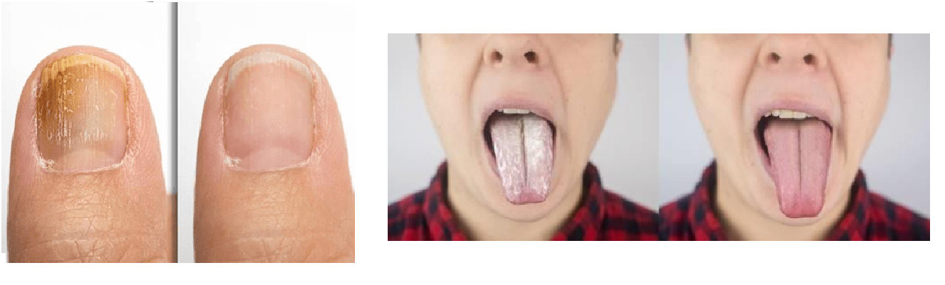 fungal-infection-treatment-in-faridabad