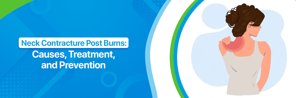 Neck Contracture Post Burns Neck Contracture Post Burns