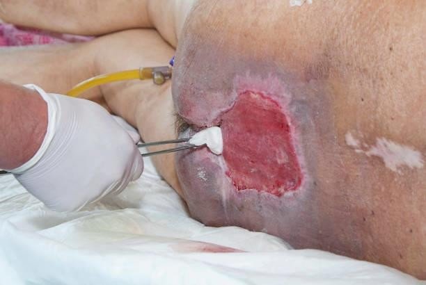 Stage Pressure Ulcers