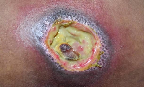 Complications of Bed sores