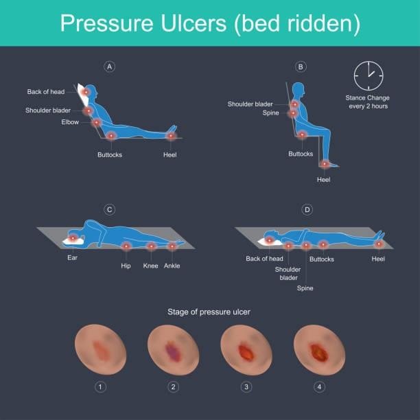 Causes and Risk Factors of Bed Sores