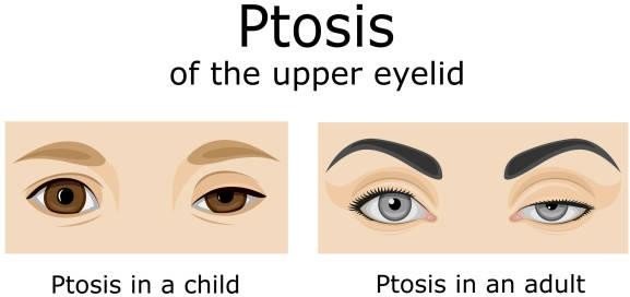 Congenital Ptosis