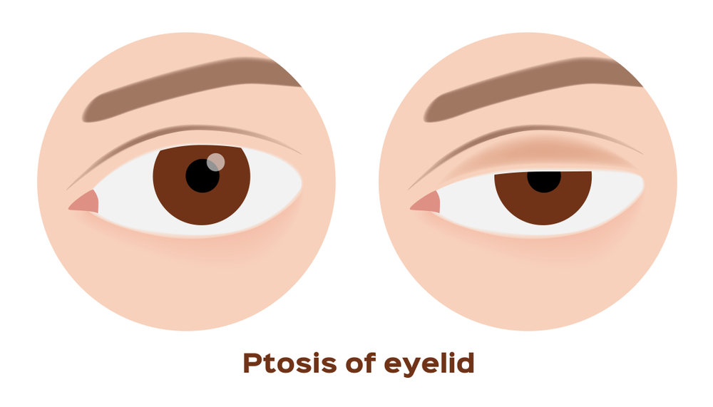 Frontalis Sling For Ptosis of eyelid