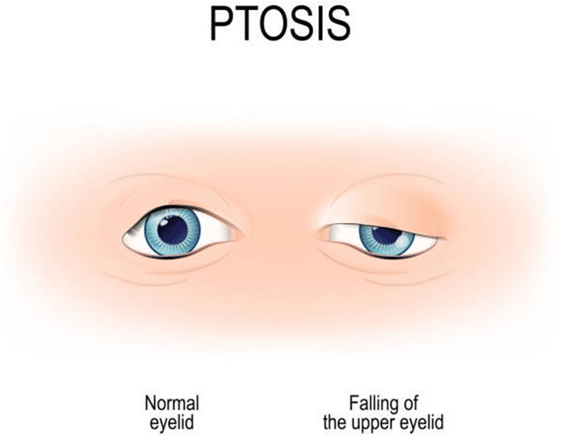 Frontalis Sling for Ptosis