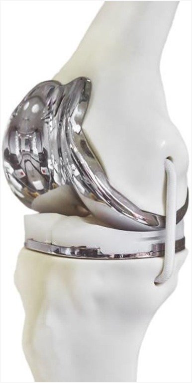 Orthopaedic Implants in Leg