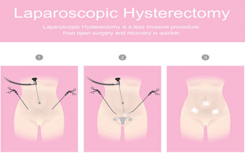 5 Years After Hysterectomy