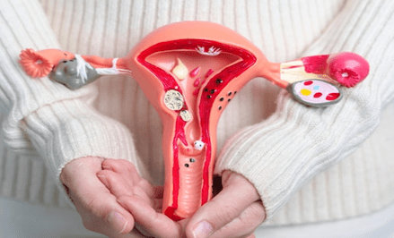 5 Years After Hysterectomy