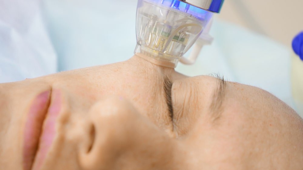 Fractional Radiofrequency Microneedling