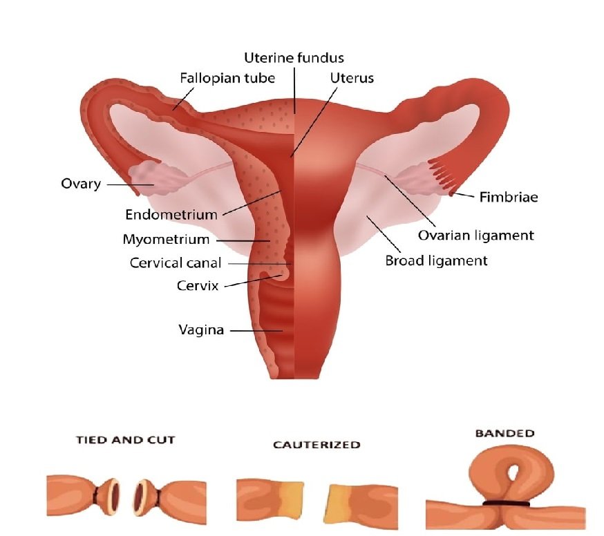 pregnant at 42 after tubal ligation