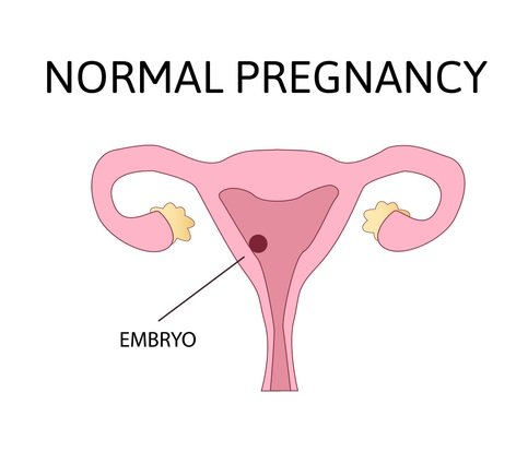 normal pregnancy after tubal ligation