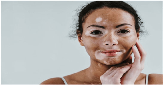 Phototherapy in Vitiligo Treatment