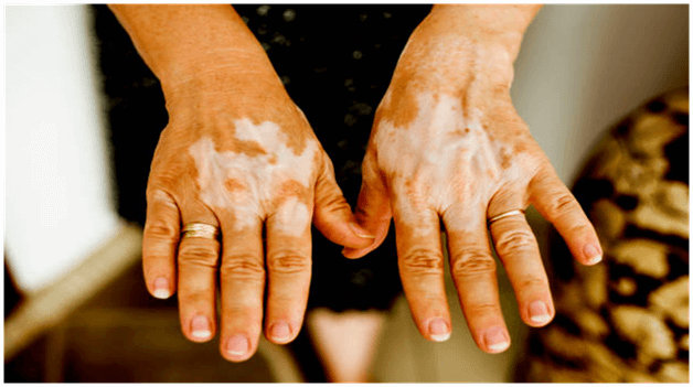 Understanding Vitiligo