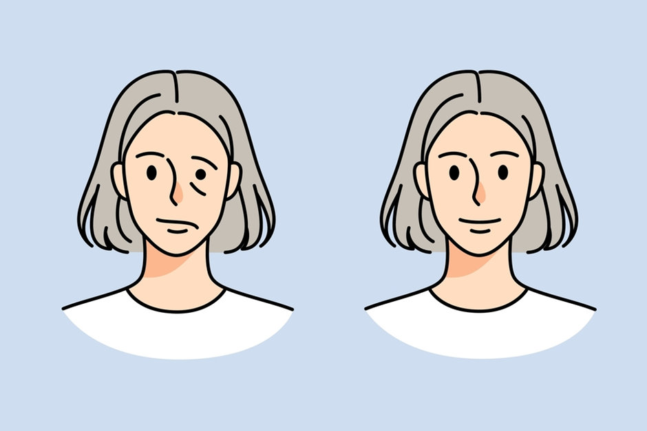 Causes of Marginal Mandibular Nerve Palsy